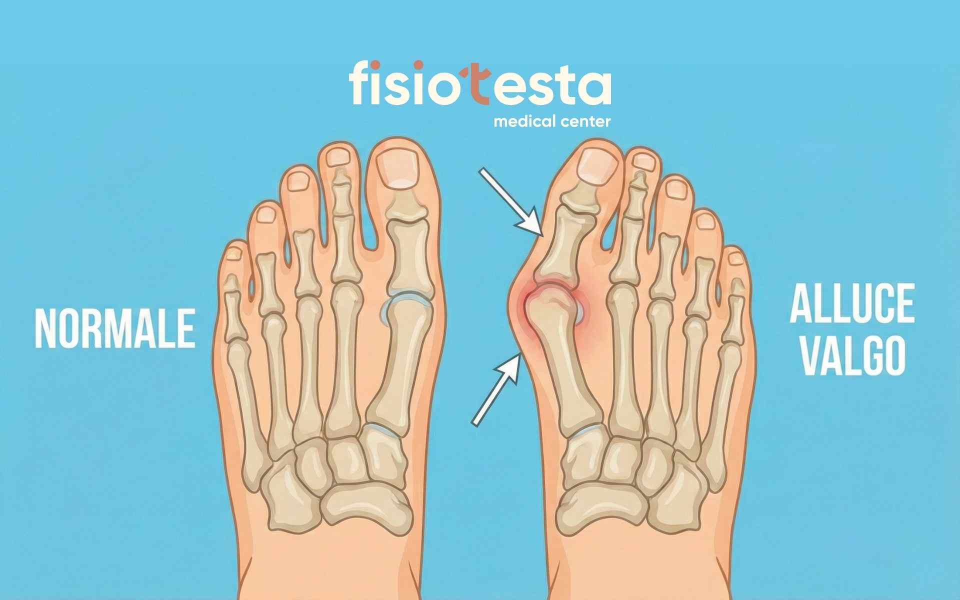 Alluce Valgo: Rimedi Efficaci Senza Intervento e Quando Serve Davvero Operare