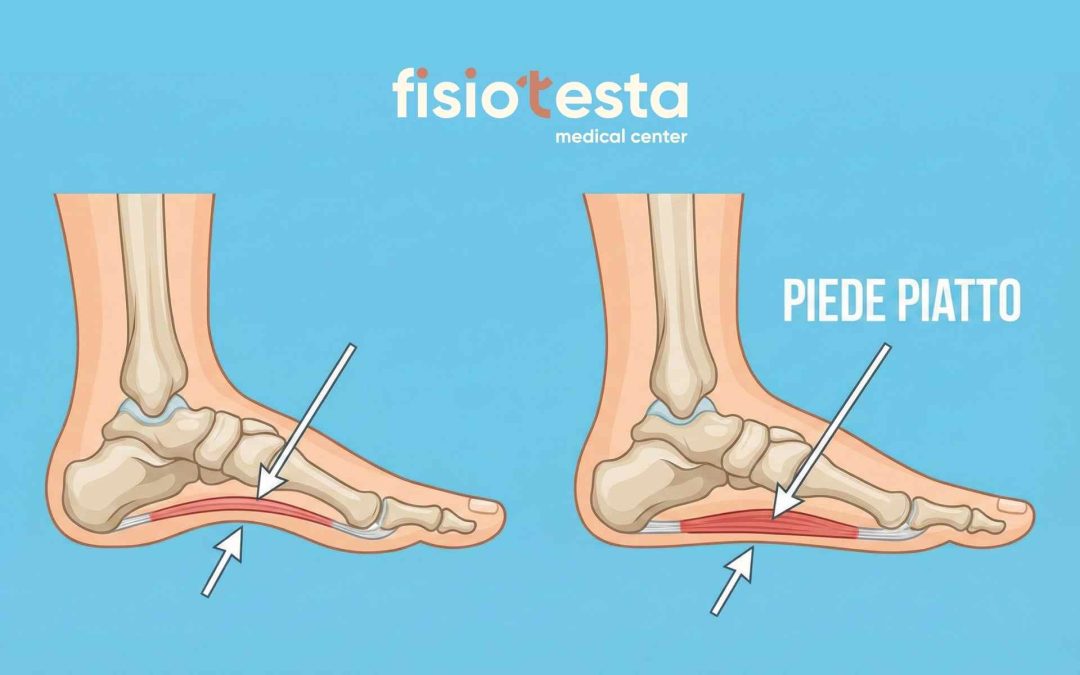 Piede piatto: sintomi, cause e trattamenti efficaci