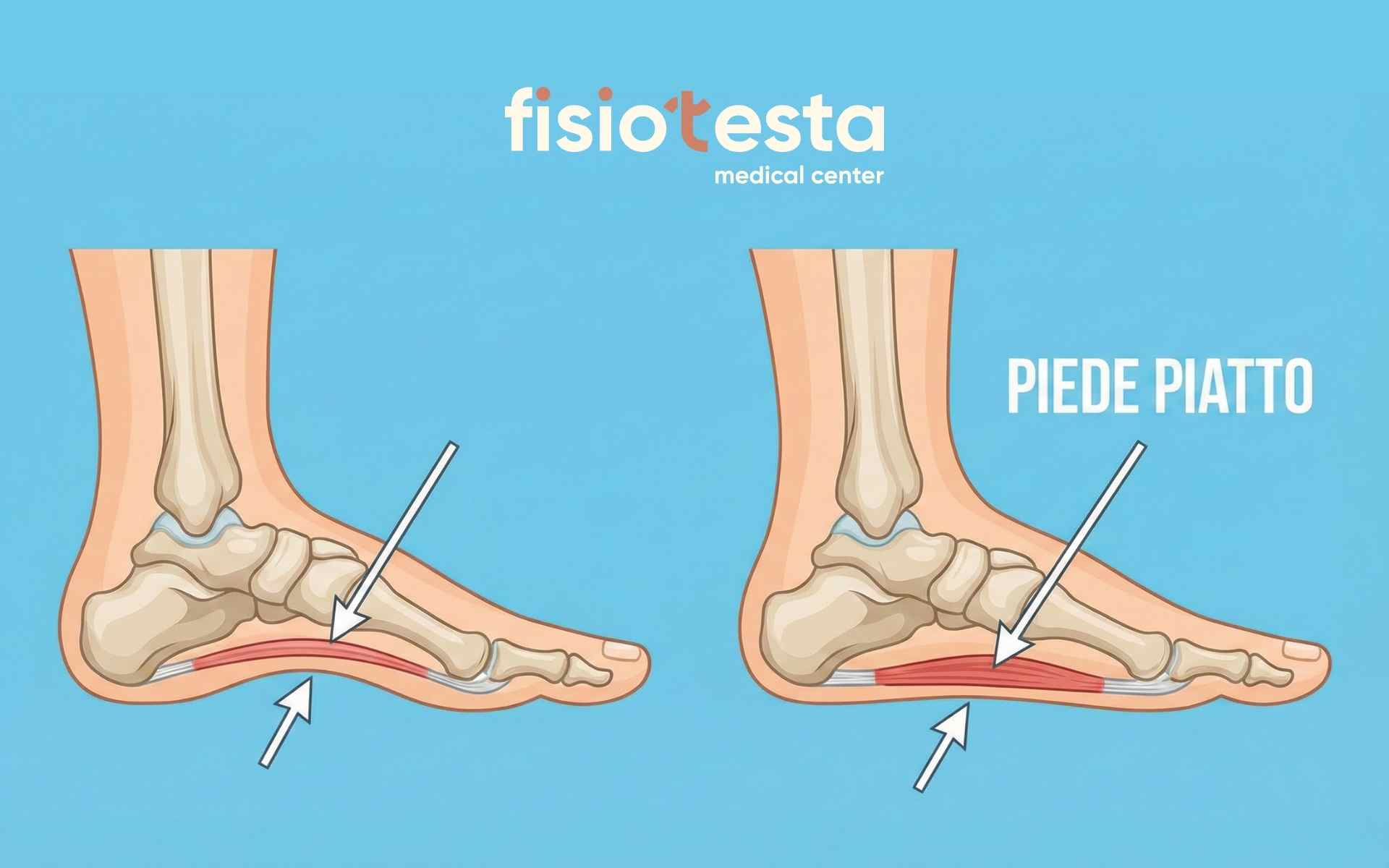 Piede piatto: sintomi, cause e trattamenti efficaci