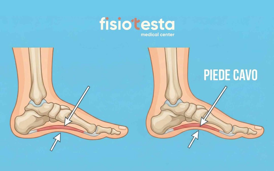 Piede cavo: come riconoscerlo, sintomi e trattamenti efficaci